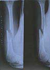 项进英　上臂被北京恶警迫害骨折的　X-ray　摄片